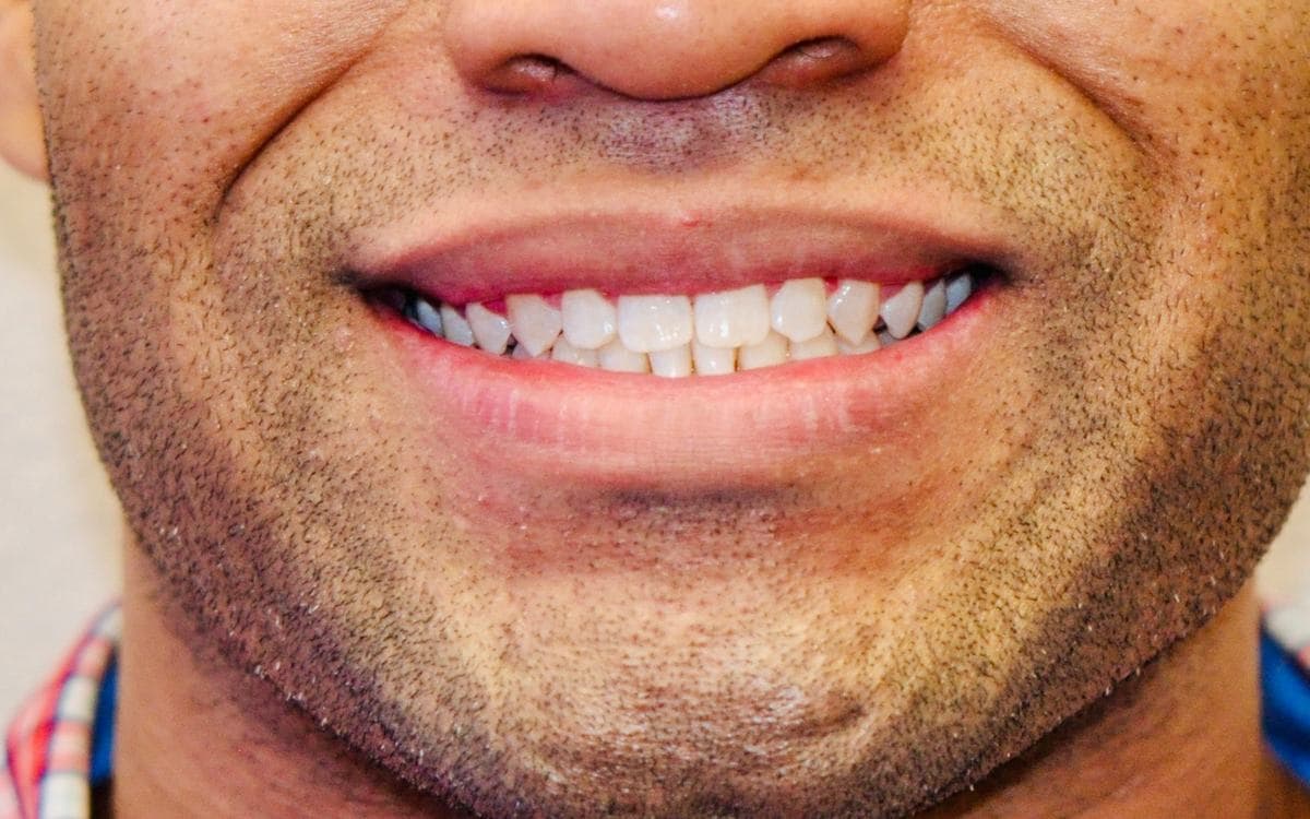 Clear Aligners