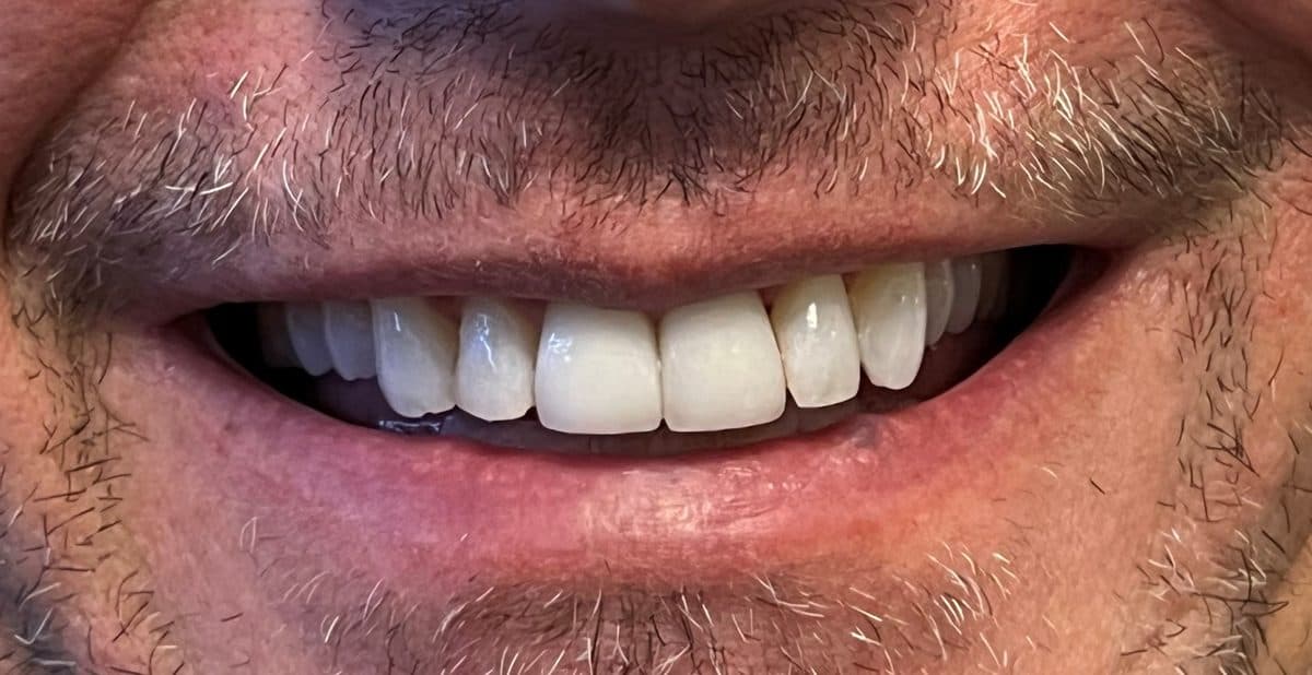 Dental Crowns