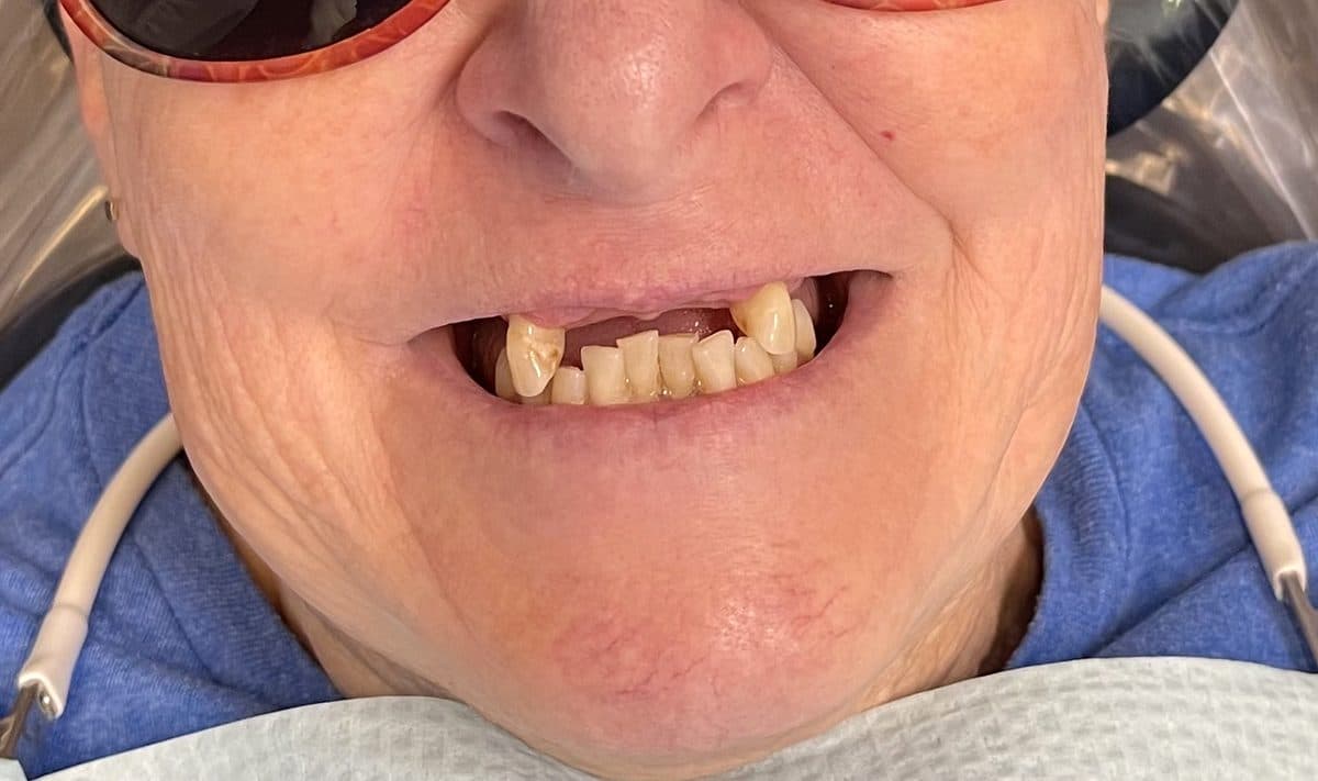 Dentures