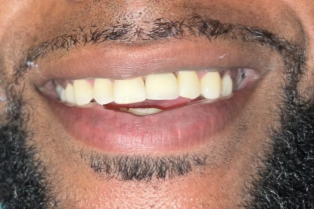 Dental Implants